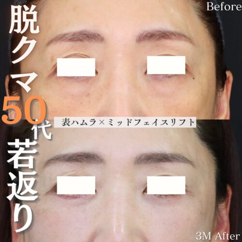 症例解説：表ハムラ法×ミッドフェイスリフト併用術